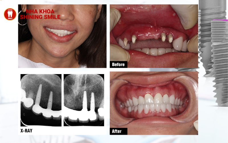 Trụ Implant Đức: Chất Lượng Đỉnh Cao, Chi Phí Phải Chăng