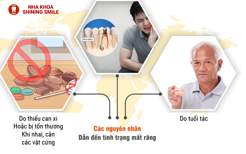 Các Phương Pháp Trồng Răng Hiện Đại: Đâu Là Lựa Chọn Hoàn Hảo Cho Bạn?