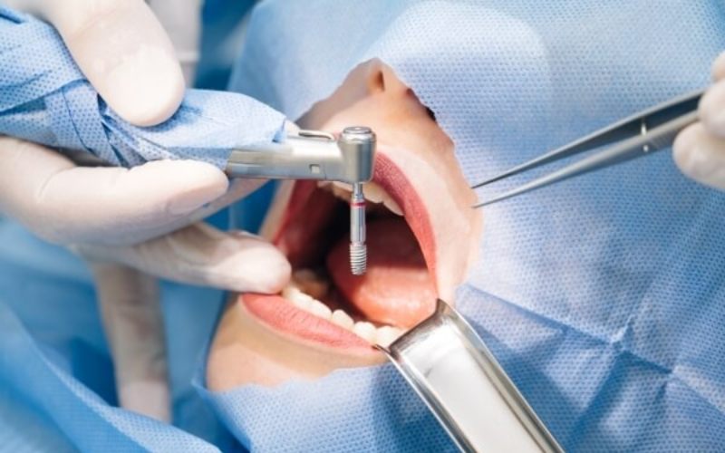 Răng Implant Sử Dụng Được Bao Lâu? Bí Quyết Giữ Răng Luôn Bền Đẹp