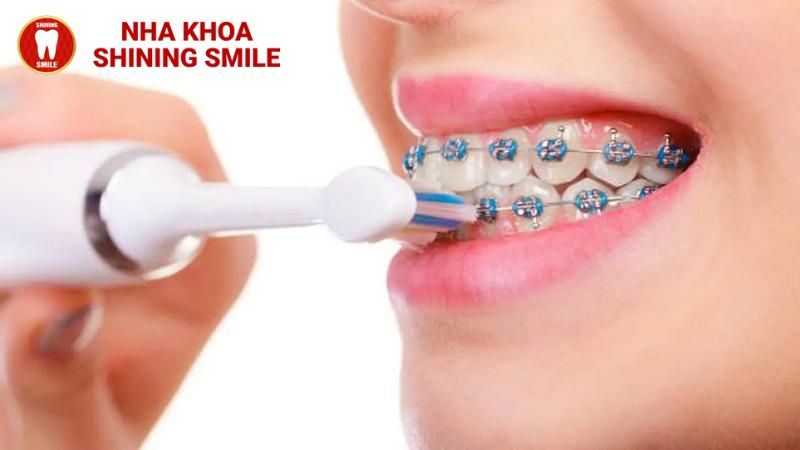 Niềng Răng Có Nên Dùng Bàn Chải Điện Không? Tìm Hiểu Lợi Ích Và Hướng Dẫn Sử Dụng