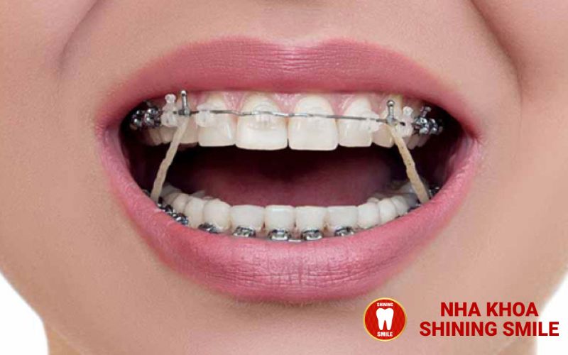 Niềng Răng Nanh: Giải Pháp Hiệu Quả Cho Răng Mọc Lệch Và Ngầm
