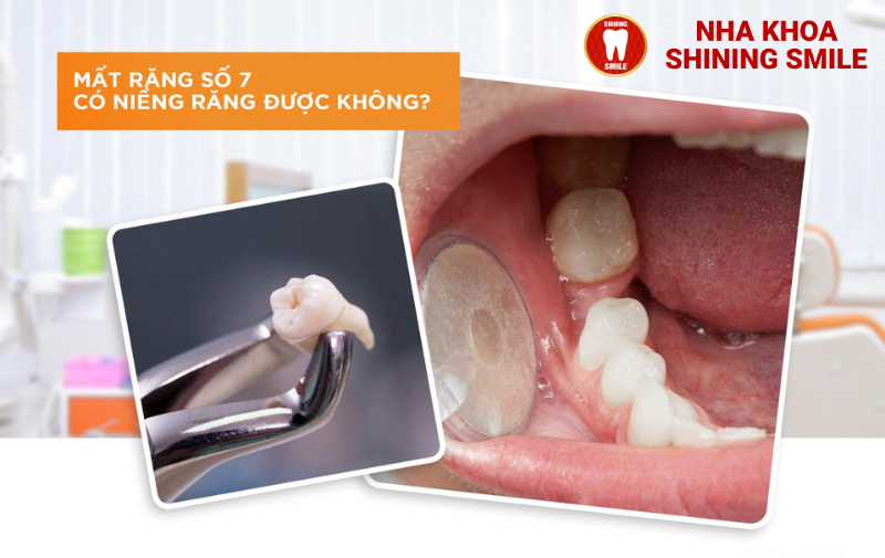 Mất Răng Số 7: Có Thể Niềng Răng Để Khắc Phục Không?