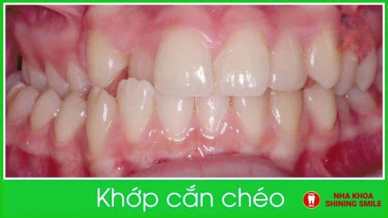 Tầm Quan Trọng của Việc Điều Trị Niềng Răng Khớp Cắn Chéo Sớm