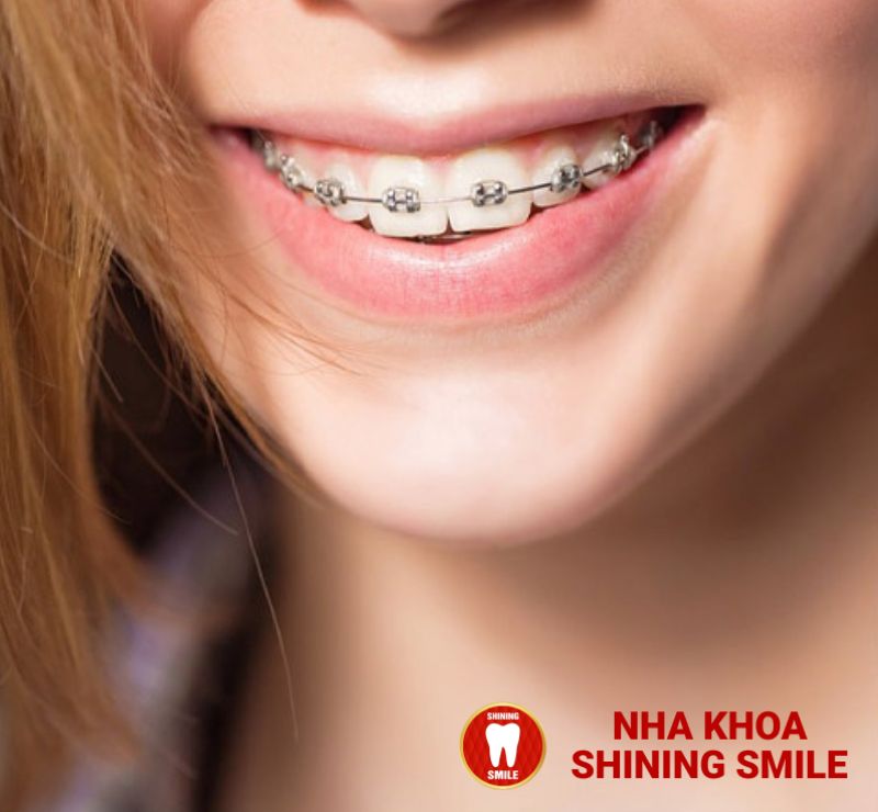 18 Tuổi Niềng Răng Được Không? Lời Khuyên Từ Chuyên Gia