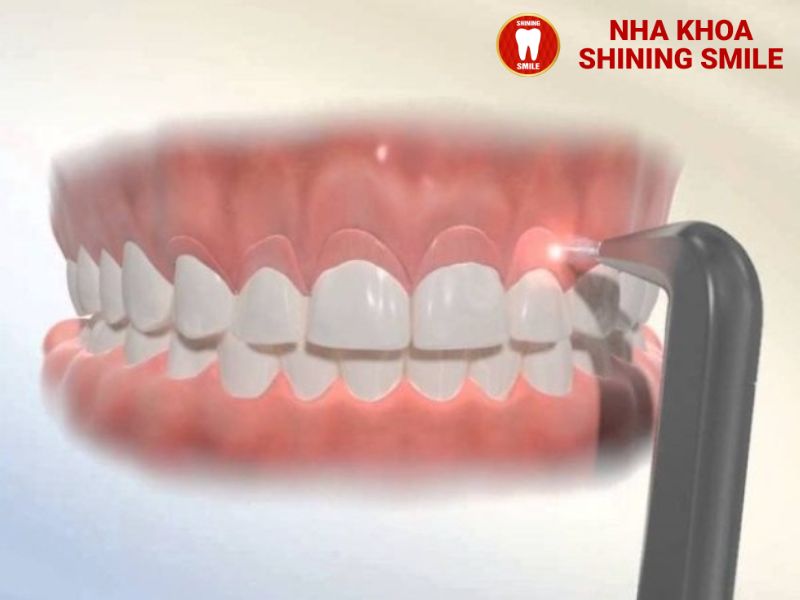 Vì Sao Niềng Răng Cần Cắt Lợi? Những Điều Bạn Cần Biết