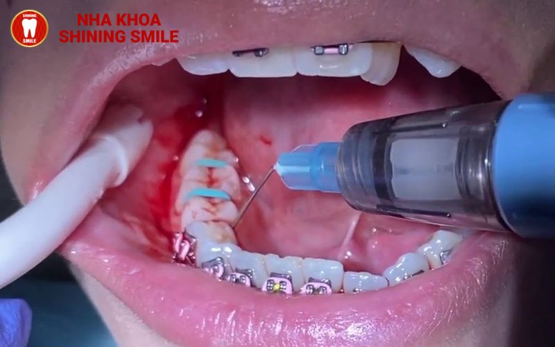 Chảy Máu Chân Răng Khi Niềng: Nguyên Nhân và Giải Pháp