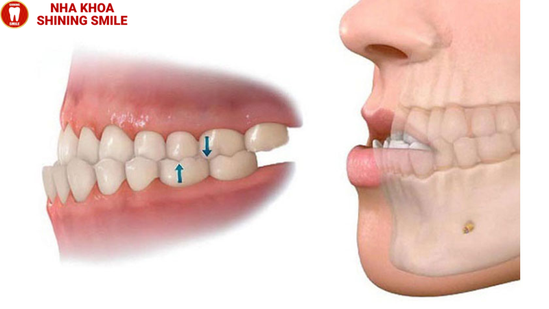 Bọc Răng Sứ Khớp Cắn Ngược: Giải Pháp Hiệu Quả