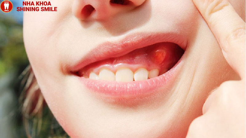 Xử Lý Khi Bọc Răng Sứ Bị Ngứa: Nguyên Nhân Và Cách Khắc Phục