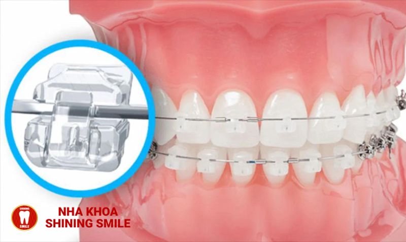 Niềng Răng Mắc Cài Sứ Trong Bao Lâu? Bí Ẩn Đằng Sau Thời Gian Đặc Biệt