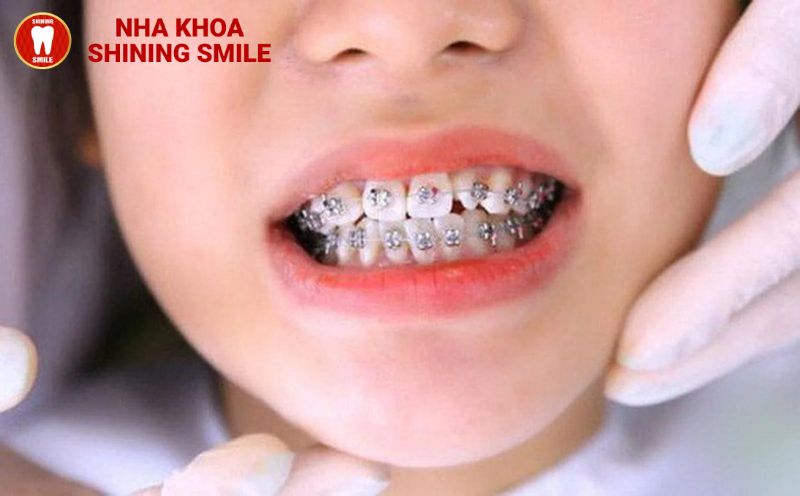 Niềng Răng Cho Trẻ Em: Lựa Chọn Thông Minh hay Mối Lo Ngại?