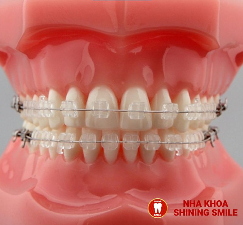 Mắc Cài Damon Có Thực Sự Mang Đến Hiệu Quả Vượt Trội?