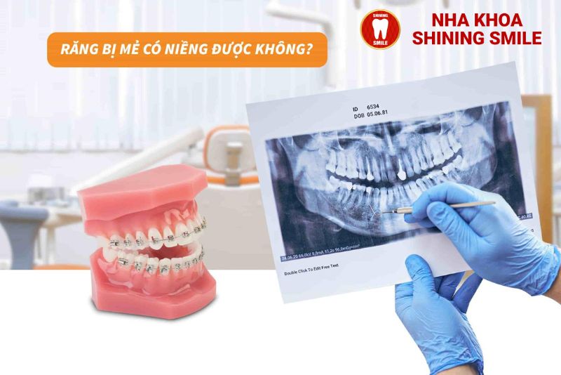 Răng Mẻ Có Thể Niềng Không - Giải Đáp Tất Cả