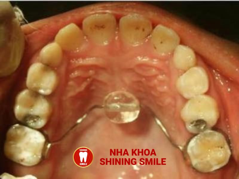 Tật Đẩy Lưỡi Khi Niềng Răng: Ảnh Hưởng Và Giải Pháp Khắc Phục