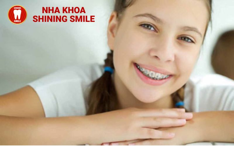 Niềng Răng ở Tuổi 19: Thời Gian Cần Thiết Và Cách Rút Ngắn Quá Trình Điều Trị