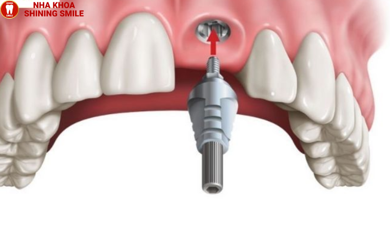 ch-hang-trai-nghiem-tot-nhat-hien-nay-ban-co-the-thuc-hien-nho-rang-va-cay-implant-cung-mot-luc-tuc-la-trong-rang-1.png