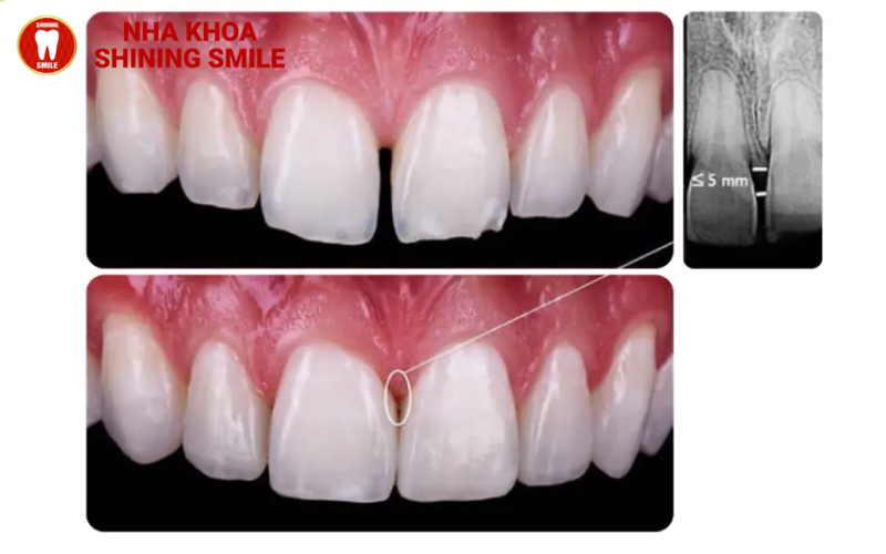 Giá Trám Răng Cửa Thưa: Bảng Giá Mới Nhất!