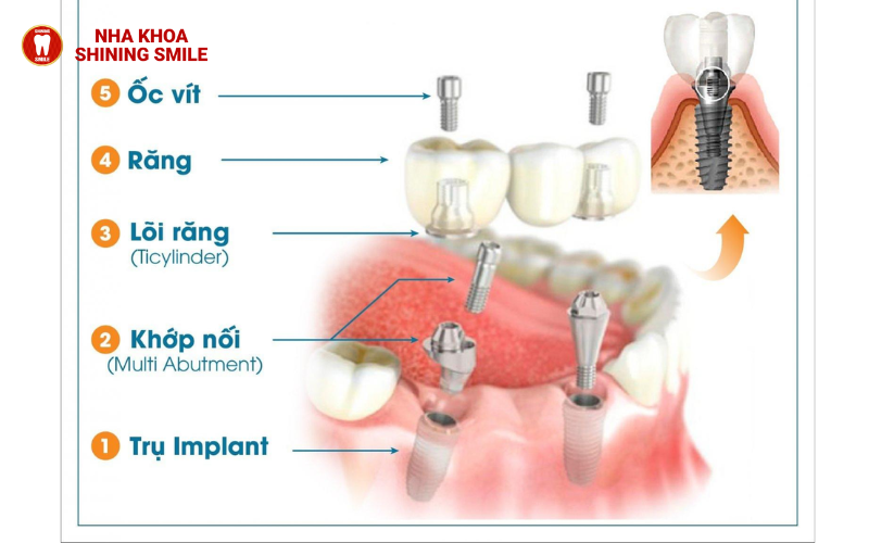 ch-hang-trai-nghiem-tot-nhat-hien-nay-ban-co-the-thuc-hien-nho-rang-va-cay-implant-cung-mot-luc-tuc-la-trong-rang-18-2.png