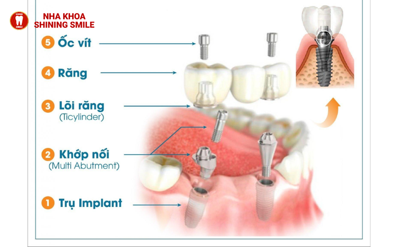 Phục Hình Bắt Vít Trên Implant: Quy Trình Và Ưu Điểm Nổi Bật!
