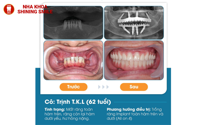 ch-hang-trai-nghiem-tot-nhat-hien-nay-ban-co-the-thuc-hien-nho-rang-va-cay-implant-cung-mot-luc-tuc-la-trong-rang-19.png