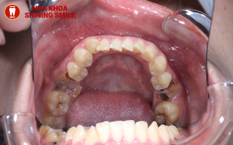 Kéo Răng Số 7 Thay Răng Số 6 Bao Nhiêu Tiền? Tìm Hiểu Ngay!