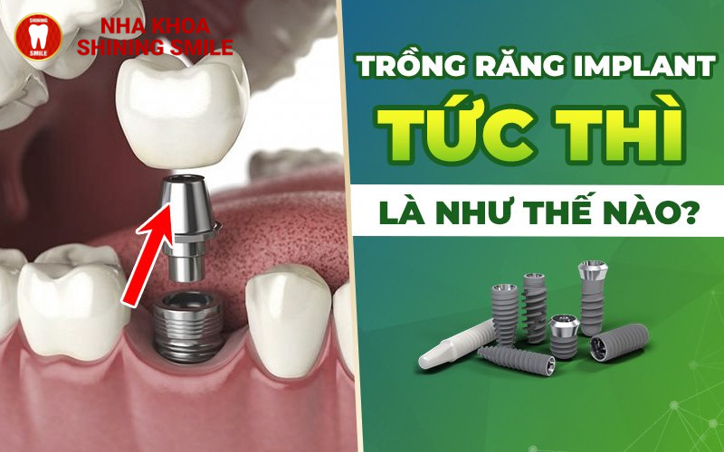 Cấy Ghép Implant Tức Thì: Phục Hồi Nhanh Chóng Răng Mất!