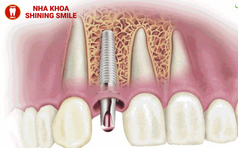 ch-hang-trai-nghiem-tot-nhat-hien-nay-ban-co-the-thuc-hien-nho-rang-va-cay-implant-cung-mot-luc-tuc-la-trong-rang-20-2.png