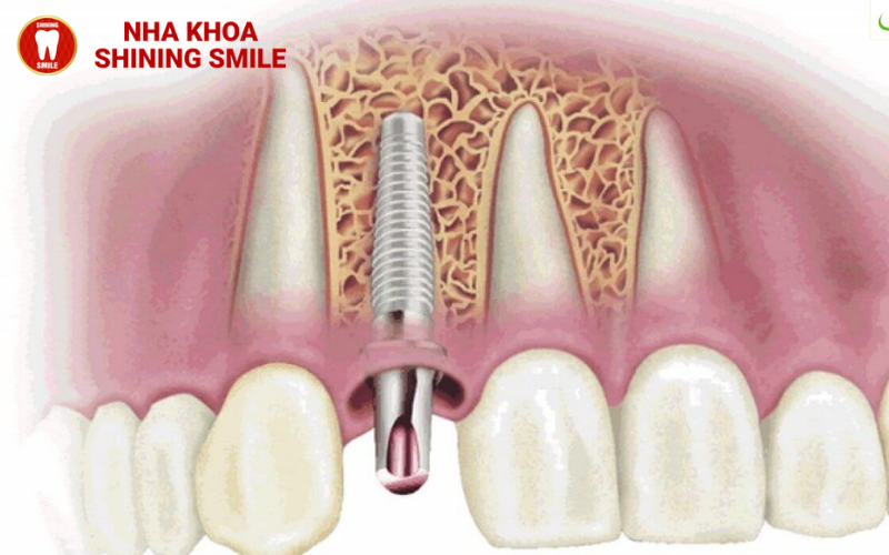 Răng Implant Bị Đào Thải? Nguyên Nhân Và Cách Khắc Phục!