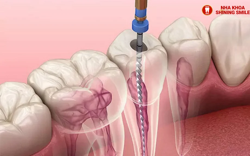 ch-hang-trai-nghiem-tot-nhat-hien-nay-ban-co-the-thuc-hien-nho-rang-va-cay-implant-cung-mot-luc-tuc-la-trong-rang-24.png