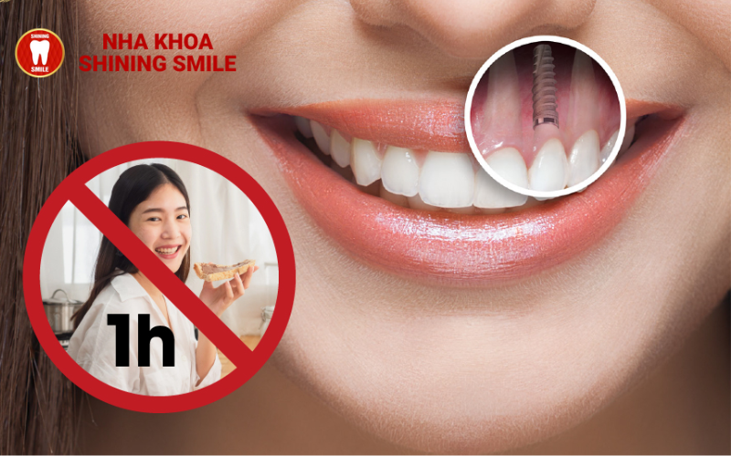 Trồng Răng Implant Bao Lâu Thì Ăn Được? Hướng Dẫn Chi Tiết!