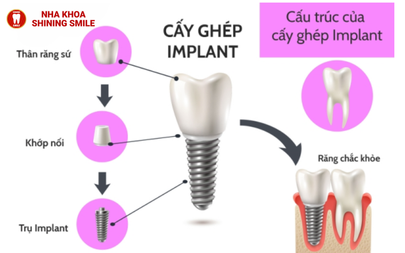 ch-hang-trai-nghiem-tot-nhat-hien-nay-ban-co-the-thuc-hien-nho-rang-va-cay-implant-cung-mot-luc-tuc-la-trong-rang-29-3.png