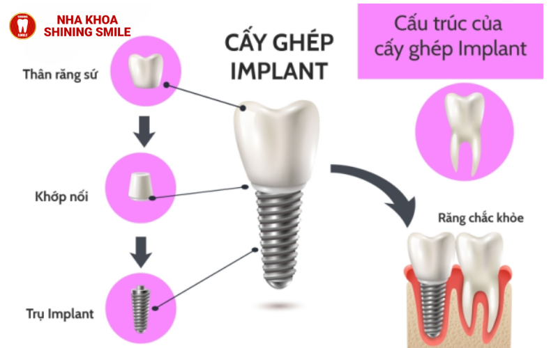 Trồng Răng Implant Có Chụp MRI Được Không? Giải Đáp Thắc Mắc!