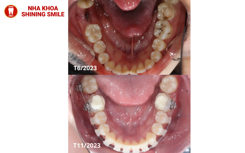 ch-hang-trai-nghiem-tot-nhat-hien-nay-ban-co-the-thuc-hien-nho-rang-va-cay-implant-cung-mot-luc-tuc-la-trong-rang-4.png