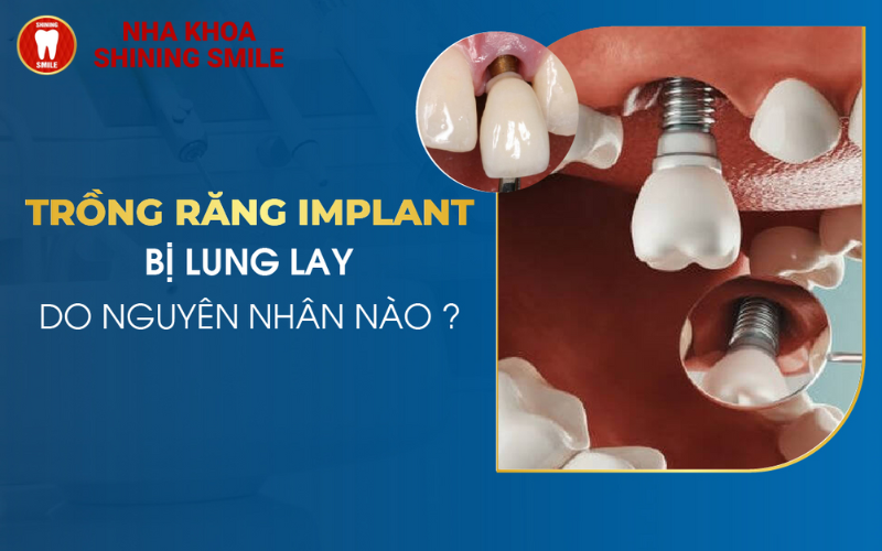 ch-hang-trai-nghiem-tot-nhat-hien-nay-ban-co-the-thuc-hien-nho-rang-va-cay-implant-cung-mot-luc-tuc-la-trong-rang-7-2.png