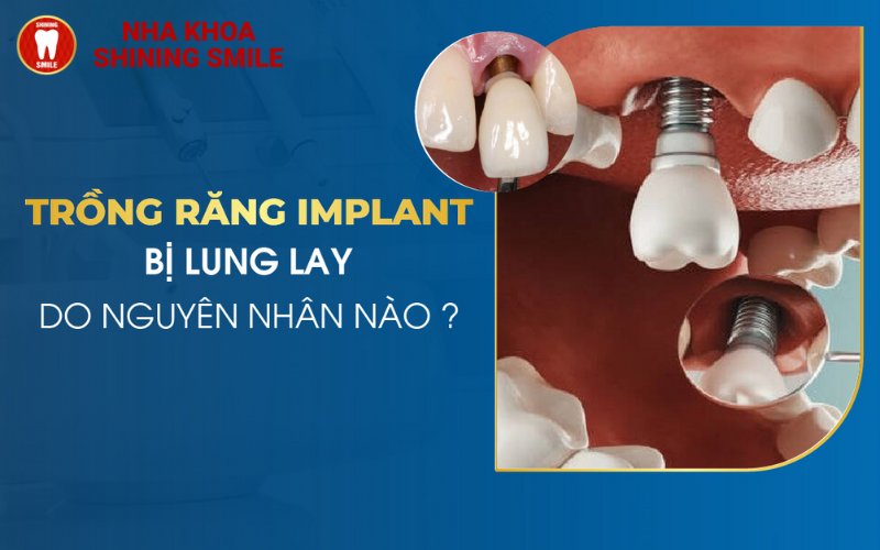 Răng Implant Bị Lung Lay? Nguyên Nhân Và Cách Khắc Phục Hiệu Quả!