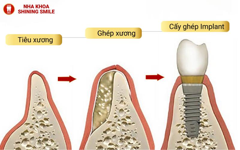 ch-hang-trai-nghiem-tot-nhat-hien-nay-ban-co-the-thuc-hien-nho-rang-va-cay-implant-cung-mot-luc-tuc-la-trong-rang-9.png