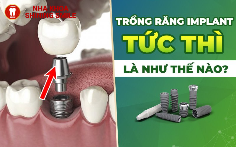 ch-hang-trai-nghiem-tot-nhat-hien-nay-ban-co-the-thuc-hien-nho-rang-va-cay-implant-cung-mot-luc-tuc-la-trong-rang.png