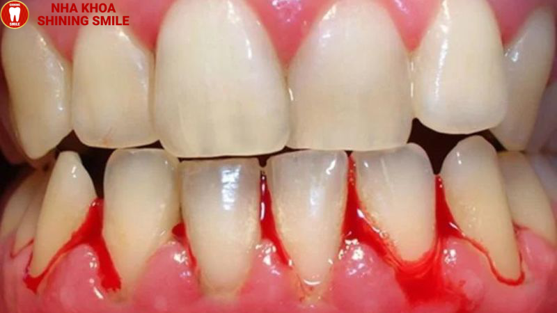 Bọc Răng Sứ Và Những Biến Chứng Khó Lường