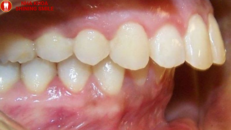 Răng Lộn Xộn Có Bọc Sứ Được Không? Lời Khuyên Từ Bác Sĩ