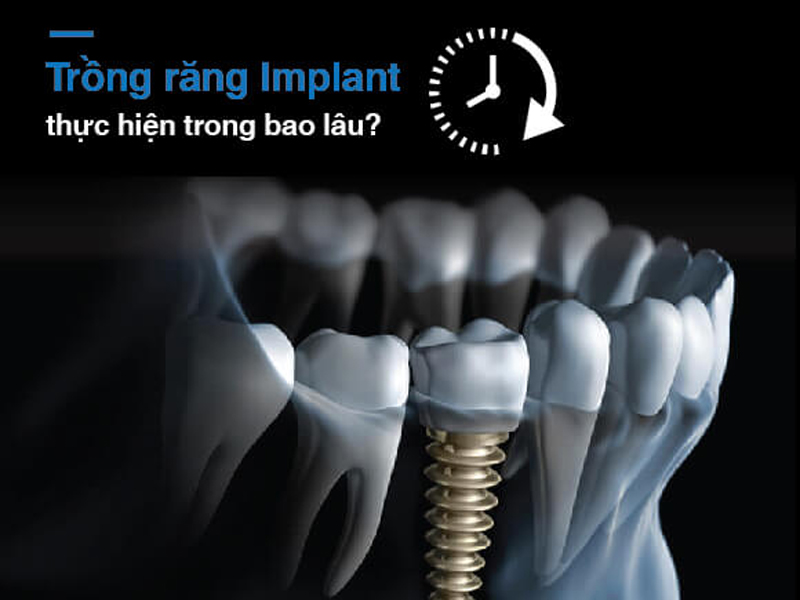 trong-rang-implant-mat-bao-lau-2.jpg