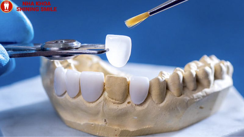 Bọc Răng Sứ Có Cần Nhổ Răng Không? Tư Vấn Từ Chuyên Gia