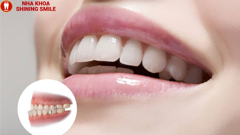 Bọc Răng Sứ Có Làm Thay Đổi Khuôn Mặt? Sự Thật Ra Sao?