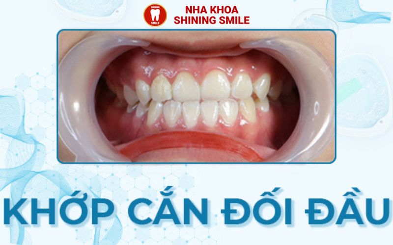 Cách Khắc Phục Niềng Răng Khớp Cắn Đối Đầu Hiệu Quả