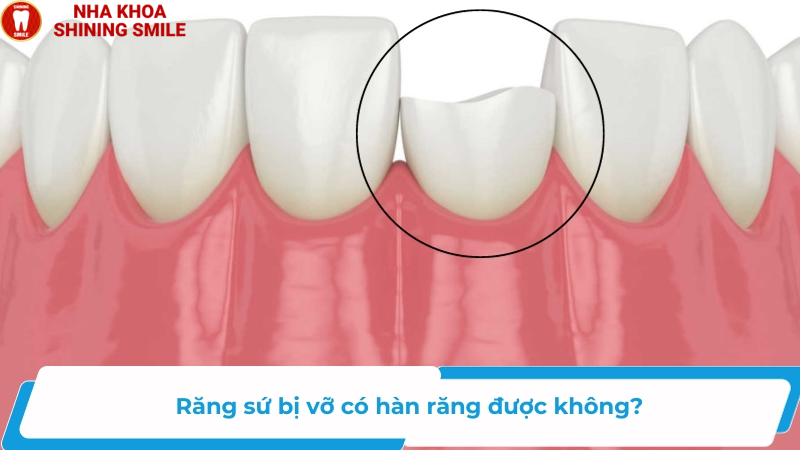 Răng Sứ Bị Vỡ Có Hàn Được Không? Hướng Dẫn Xử Lý