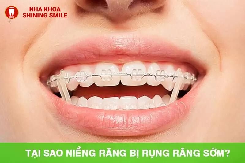 Niềng Răng Có Bị Rụng Răng Sớm Không?