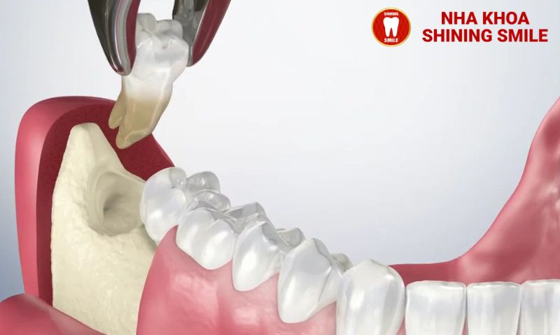 Niềng Răng Khi Chưa Mọc Răng Khôn: Có Khả Thi Không?