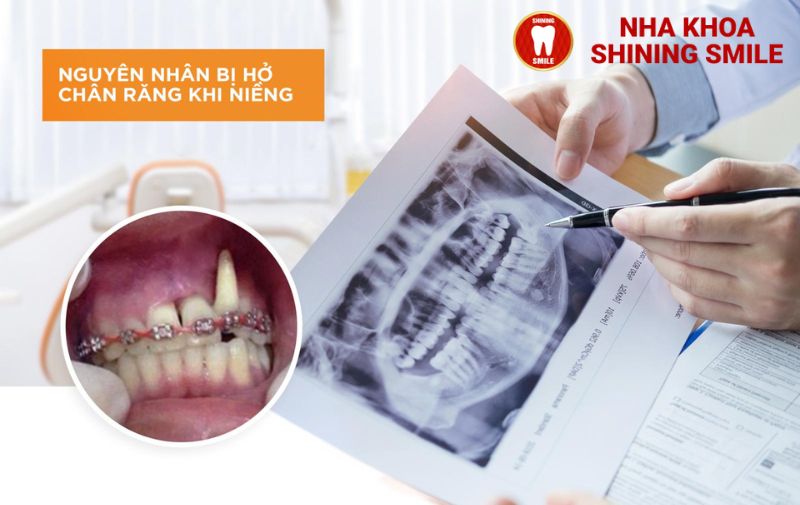 Giải Mã Hiện Tượng Niềng Răng Bị Hở Chân Răng