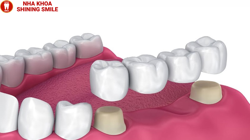 Bọc Răng Sứ Dính Liền: Có Nên Hay Không?
