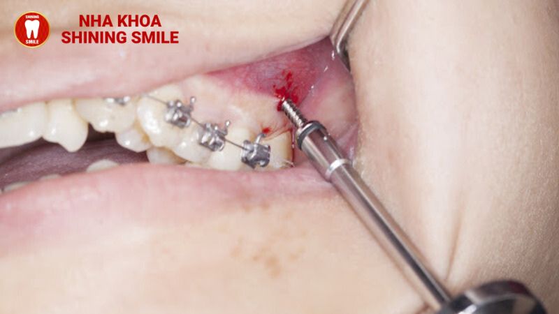Nguyên Nhân và Cách Khắc Phục Khi Cắm Vít Niềng Răng Bị Sưng Viêm