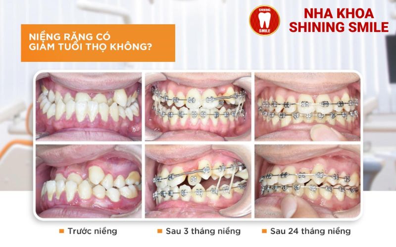 Sự Thật Về Niềng Răng: Có Làm Giảm Tuổi Thọ Không?