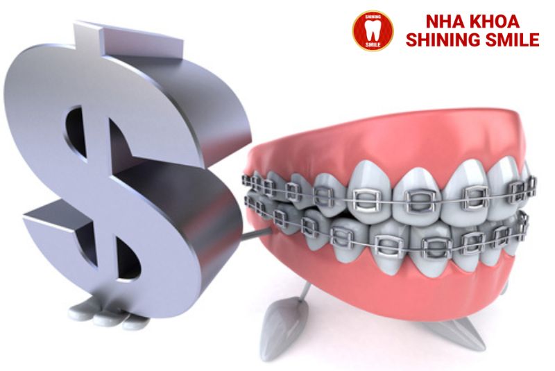 Chi Phí Niềng 2 Răng Cửa Bị Hô: Những Điều Bạn Cần Biết